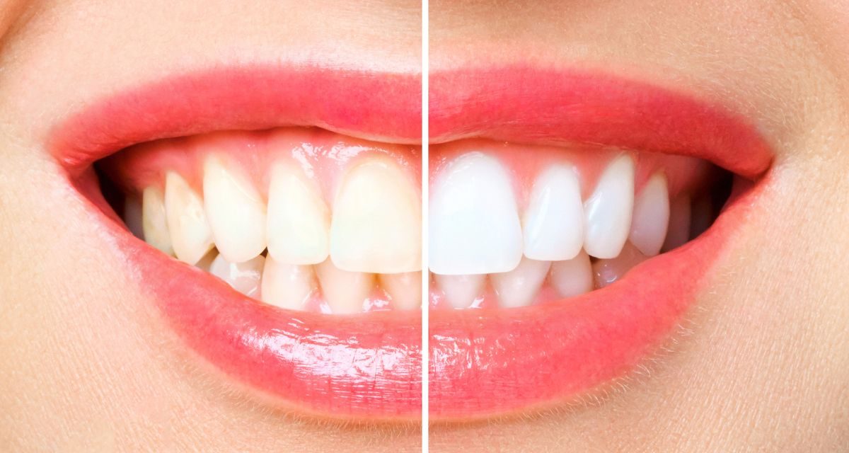 Sbiancamento Dentale o Faccette? La Scelta Giusta per i Denti Ingialliti