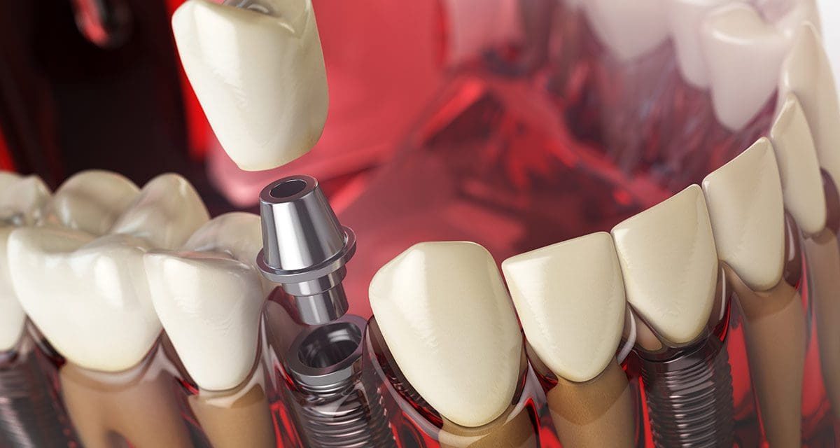 Quanto Sono Resistenti gli Impianti Dentali? Una Soluzione Duratura e Sicura